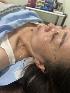 初めての鍼治療体験記｜首の違和感からの回復チャレンジ