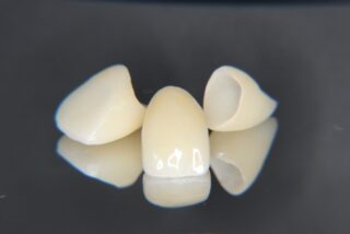 違和感は気づきのチャンス！歯が剥がれて教えてくれたこと