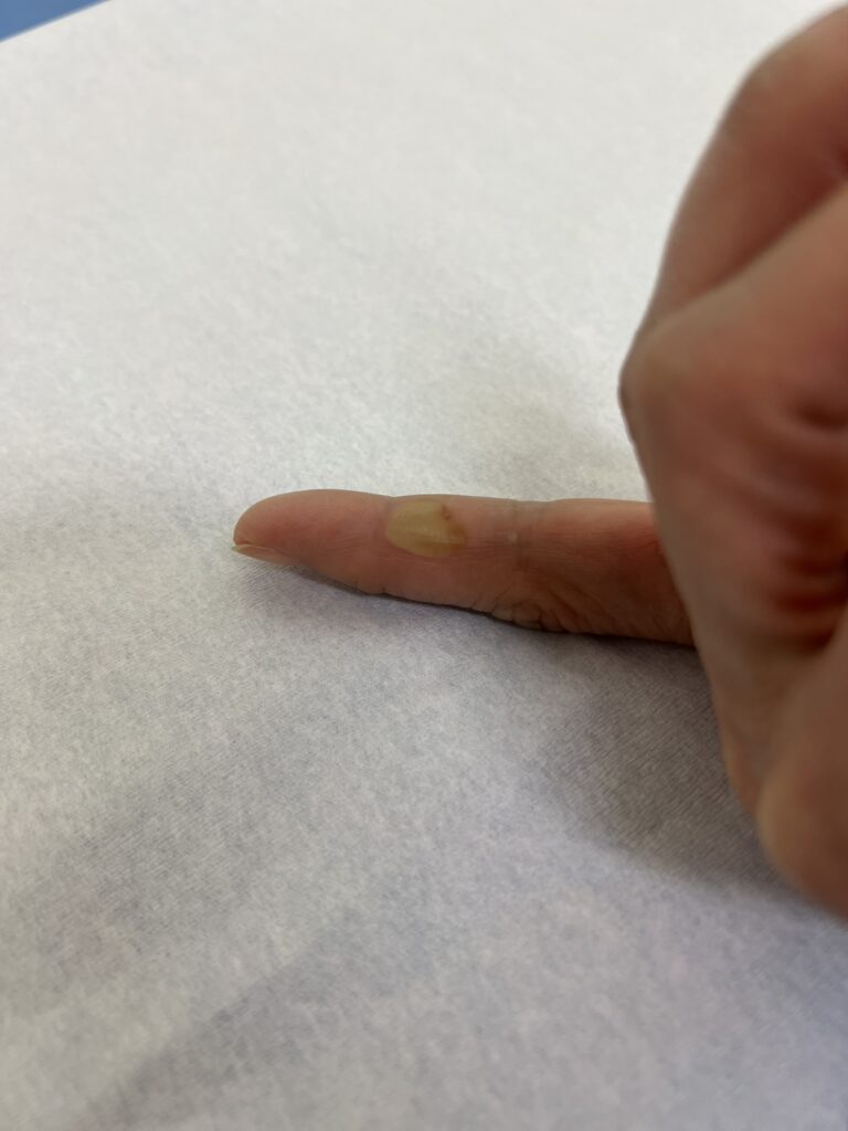 軽いケガでも仕事のパフォーマンスは低下する～健康経営の本質～